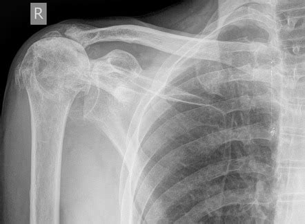 Rotator cuff tear arthropathy | Radiology Case | Radiopaedia.org