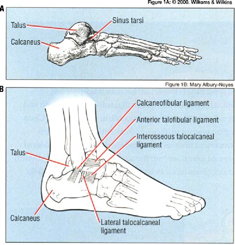 Figure 1 from The sinus tarsi syndrome: a cause of chronic ankle pain. - Semantic Scholar