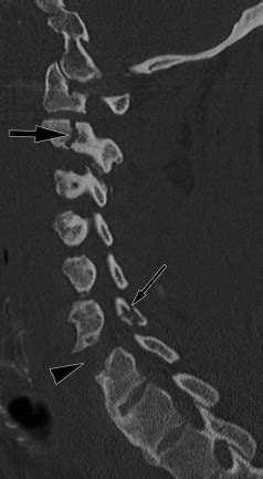 Hangman’s Fracture | Radiology Key