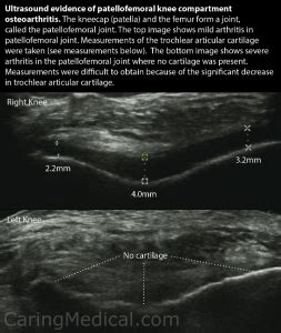 Patellofemoral osteoarthritis (Knee cap arthritis) – Caring Medical Florida