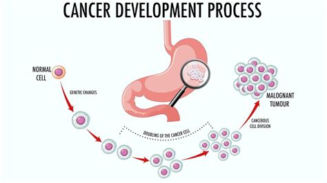 Stomach Cancer: Types, Tests For Diagnosis and New Treatments | OnlyMyHealth