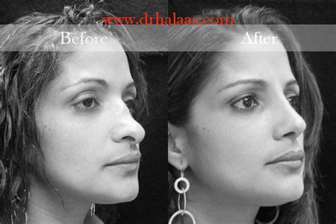 Best rhinoplasty surgeon in new york city Dr. Halaas is experienced ...