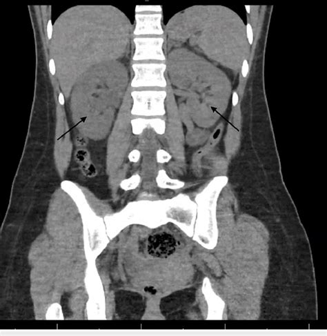 Coronal view of CT abdomen pelvis without contrast showing mild right ...