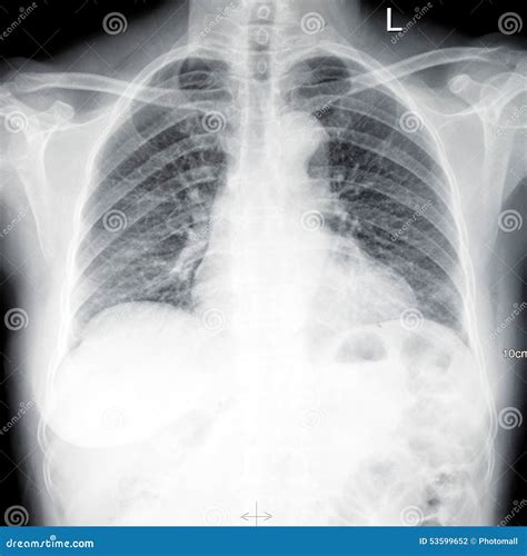 Ct Xray chest scan film stock photo. Image of bone, film - 53599652