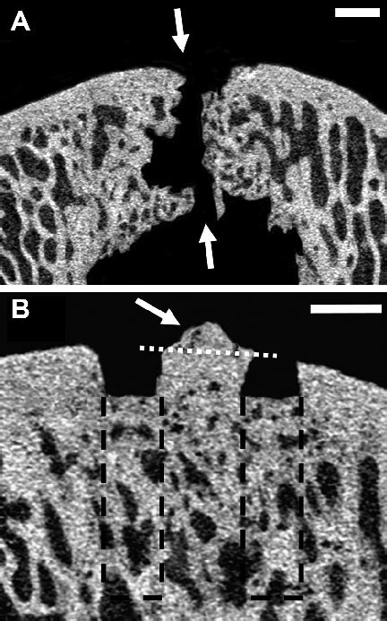 Representative micro-CT images of subchondral bone cysts (A) and ...