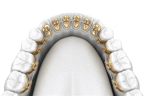 Lingual Braces | Hidden Incognito™ Braces | SmartDontics Orthodontics