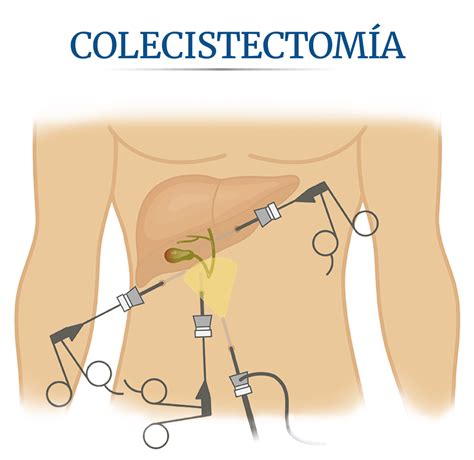 Médica Sur: Cirugía de la vesícula biliar