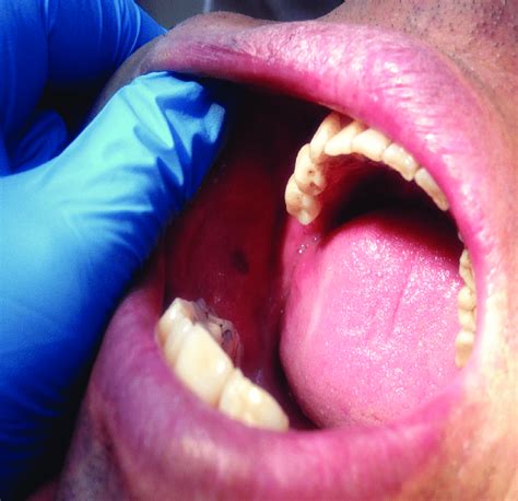 Melanotic macule detected in the buccal mucosa of the patient who... | Download Scientific Diagram