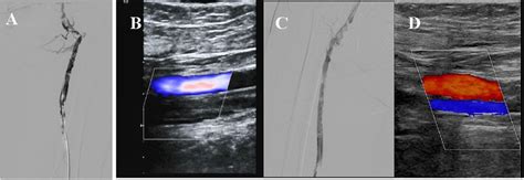 Arterial duplex scan and computed tomography angiography showed the ...