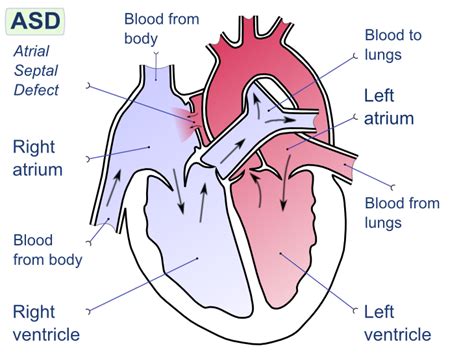 Atrial septal defect left-to-right shunt - wikidoc