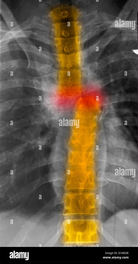 Fracture rachis thoracique Xray, section complète Photo Stock - Alamy