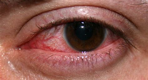 Stop Seeing Red: Get The Facts About Red Eye - Everett & Hurite Ophthalmic Association