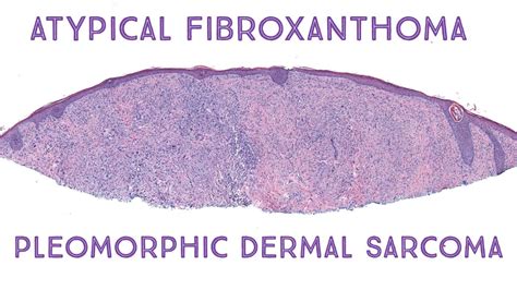 Atypical Fibroxanthoma & Pleomorphic Dermal Sarcoma (Oregon case 2) - YouTube