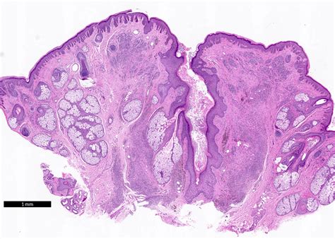 Congenital Melanocytic Nevus Histology