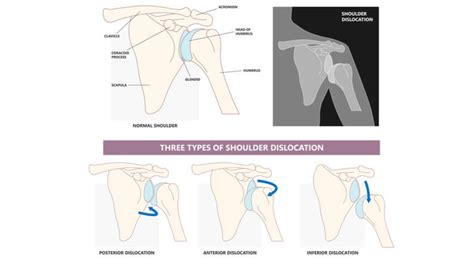 Everything You Need To Know About Shoulder Dislocation