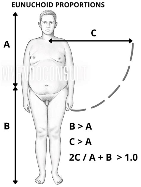 Eunuchoid Body Shape Or Habitus - My Endo Consult