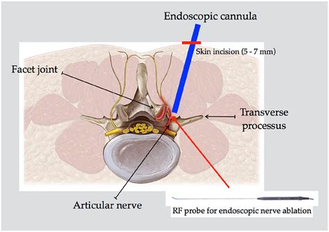 Schematic representation of endoscopic approach to dorsal ramus. Of... | Download Scientific Diagram