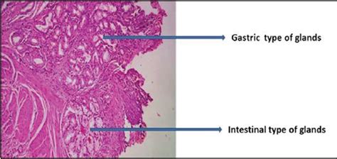 Meckel Diverticulum - Stepwards