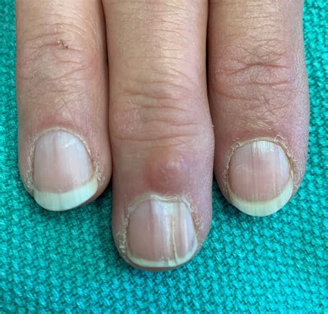 What is this Bump on my Finger? Digital Mucous Cyst - Appalachian Spring Dermatology