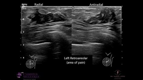 Male Gynecomastia Ultrasound