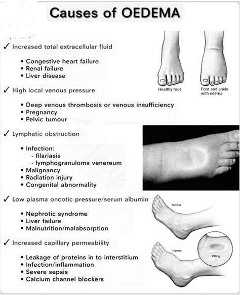 Cause of Oedema - MEDizzy