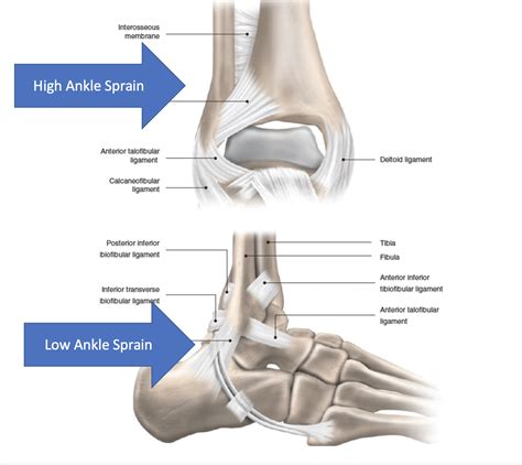 High Ankle Sprain: Sprained Ankle (Syndesmotic) - Dr. Justin Dean