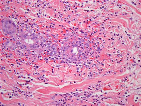 Granulomatosis with polyangiitis presenting as palpable purpura with sinusitis, hemoptysis, and ...