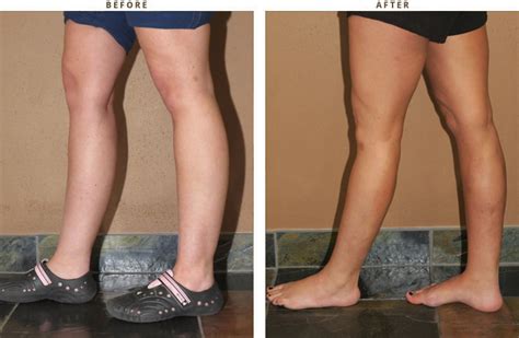 Calf Augmentation – Before and After Pictures * | Dr Turowski - Plastic Surgery Chicago