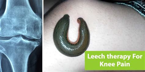 Leech Therapy in Ayurveda- Leech Therapy Centres in Delhi/NCR