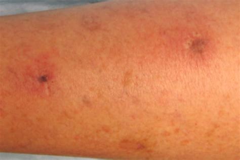 How do leg ulcers start pictures | Symptoms and pictures