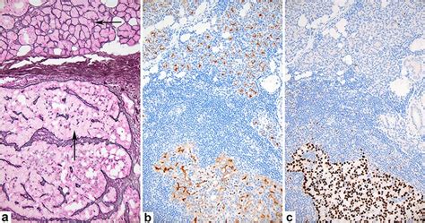 Special stains performed on AcCC (20x) A Reticulin stain showing tumor ...