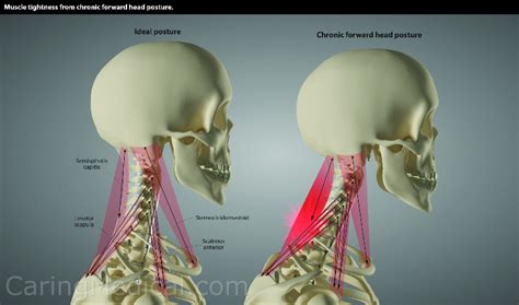 Forward head posture symptoms and complications