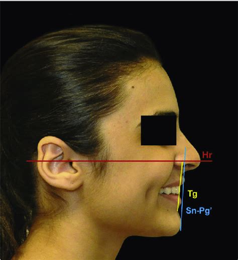 Angular measurements for the incisor inclination modifications. | Download Scientific Diagram