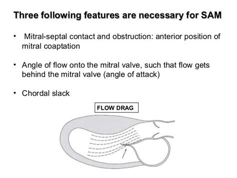 Systolic anterior motion of mitral valve - SAM