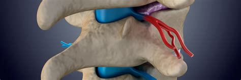 Anterior Cervical Discectomy and Fusion (ACDF) Surgery - UVNN