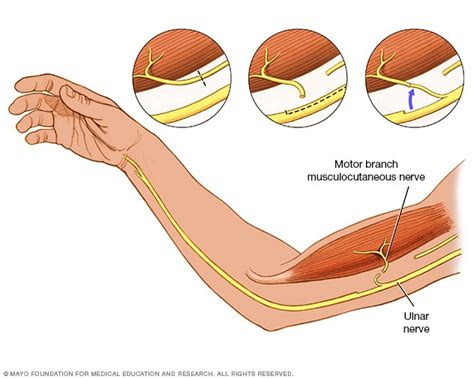 Lesiones de los nervios periféricos - Diagnóstico y tratamiento - Mayo Clinic