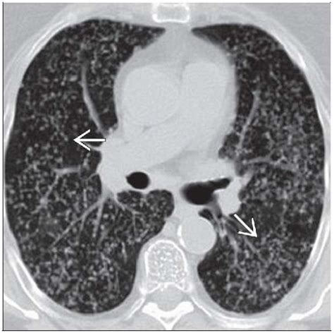 Tuberculosis, Miliary | Radiology Key