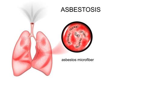 Asbestosis In Lungs: Causes, Symptoms, Treatments And Complications.