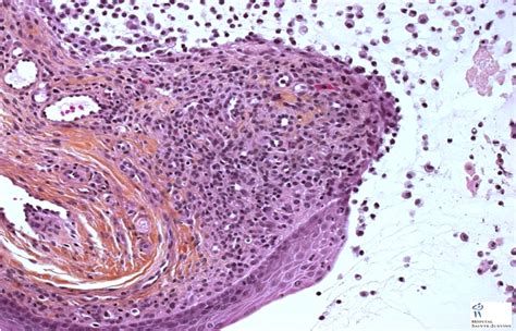 Dentistry and Medicine: Notes on Mucocele and Mucous Retention cyst-Etiology,Clinical Features ...