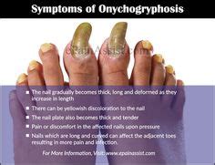 Plummer's nail: onycholysis seen in hyperthyroidism | Clinical Diagnosis | Pinterest