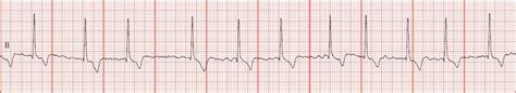 Float Nurse: EKG Rhythm Strips 56: Atrial Fibrillation