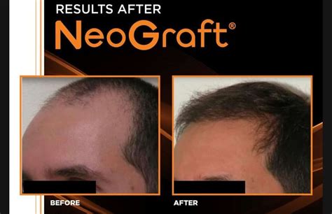 Hair Restoration Atlanta, GA & El Segundo, CA | Hair Implant