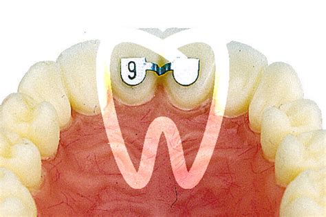 Dontalia.com - One-Stop-Shop for Dental, Ortho & Lab needs LINGUAL RETAINER CENTER TO CENTER ...