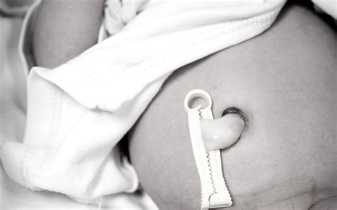 True Knot Umbilical Cord Injuries: Are They Preventable?