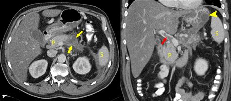 Necrotizing Pancreatitis - Radiology at St. Vincent's University Hospital