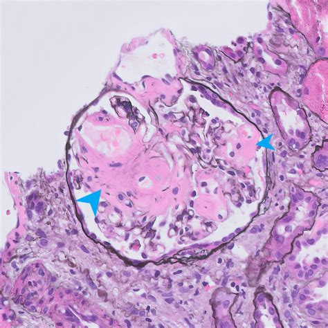 Kidney Biopsy of the Month: Amyloidosis - Renal Fellow Network