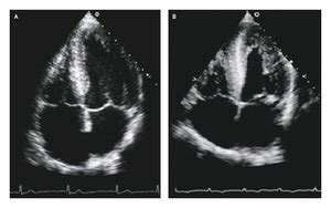 Diastolic Heart Failure | NEJM