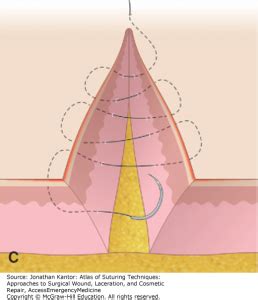 Suturing- intradermal/subcuticular pattern – Large Animal Surgery – Supplemental Notes