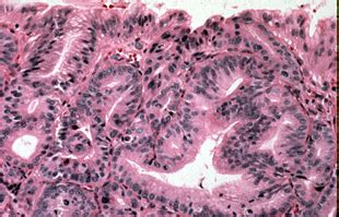 Images of Barrett’s esophagus with High-grade Dysplasia | Resources | Dept. of Laboratory ...