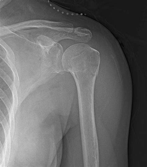 Humerus fracture, X-ray – Bild kaufen – 13623284 Science Photo Library